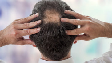 how to fight hair loss