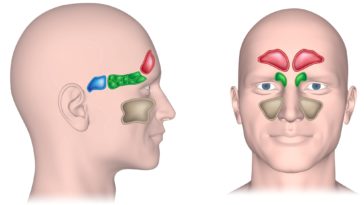 balloon sinuplasty