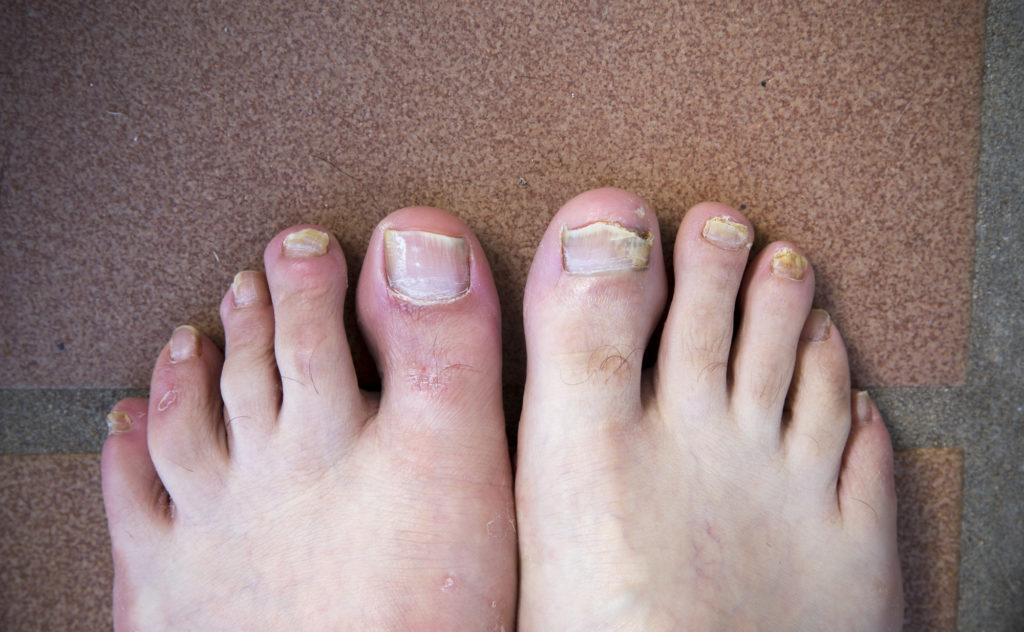 how to prevent toenail fungus