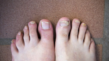 how to prevent toenail fungus